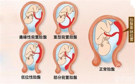 懷孕 胎盤